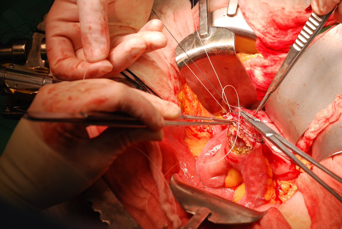 mj_pucci's tweet photo. The Left-Handed Brand New Surgery Intern 🧵 

As the new academic year kicks off, there is always the topic of “handed-ness” when discussing old school gastrointestinal surgery. Besides being considered the ‘devil’s hand,’ there is no quicker way to get under an old HPB surgeon’s https://t.co/A9yvlwqdMv
