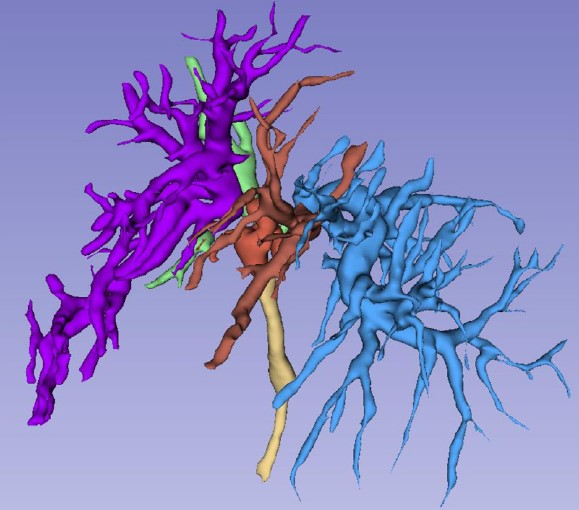 AymericBecq's tweet photo. Very excited to share my first PhD-related paper entitled ERCP 2.0: Biliary 3D-reconstruction in patients with malignant hilar stricture https://t.co/vLMRXeJzWR 
Could this change our approach in these cases?
Many thanx to @camusmarine4 ;) 
@GHUMondor #GITwitter #ERCP #Endoscopy https://t.co/Z0ClaauhXQ