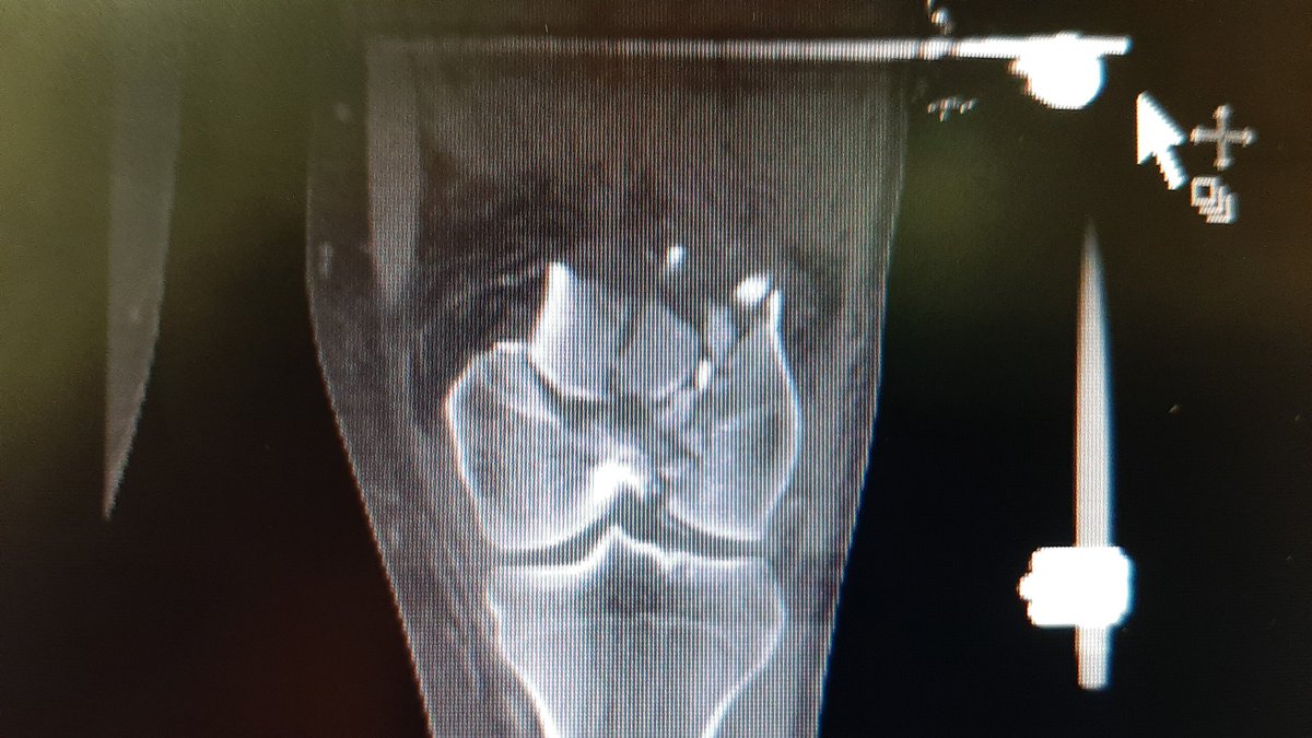 Ulinov3's tweet photo. 35a. Fx supra intercondilea femur conminuta en 2023-01-03. RAF con placa. Actualmente retardo dolor. Que hacer? Refrescamiento y aporte injerto  respetando la placa? Remover la placa y poner otra con más compresión? Gracias  #OrthoTwitter, #Orthobullets #AAOS https://t.co/zLWJNKmOR4
