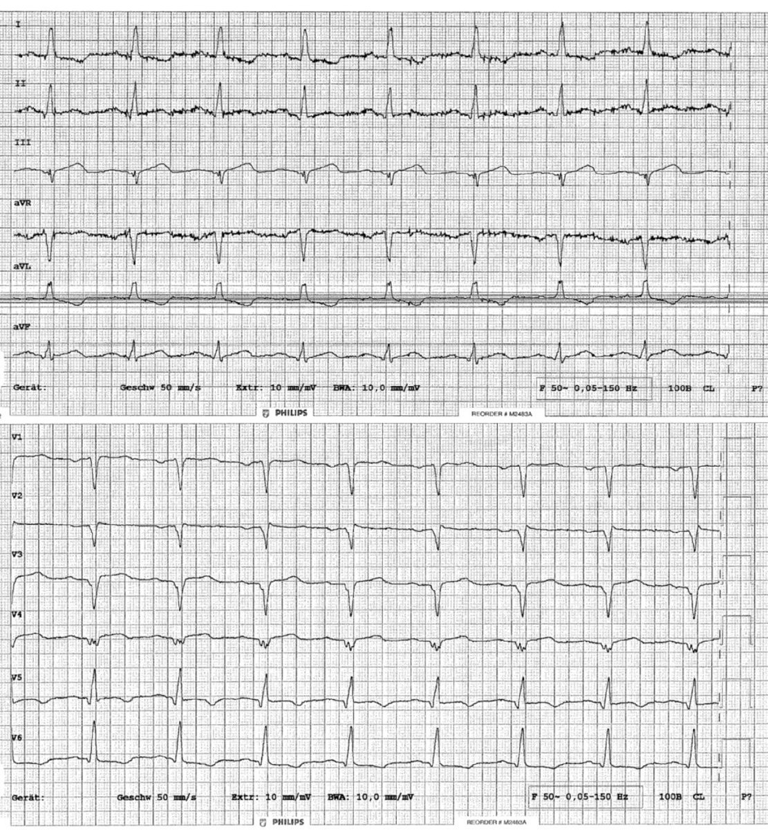 ShaojieChen1's tweet image. 50+yom, known previous anterior MI, new angina -&amp;gt; pain ++⤴️ -&amp;gt;
🚨 🏥 
trop (300+), 
#ECG 💭🧐🤔 culprit this time…

#EPeeps #PCIs 
@jongichun @BorisSchmidt5 
@AGIKinterv @AGEP_DGK 
@KardiologieHH @ANazmiCalik @Hragy @guilbon @ecgrhythms @doctorwes @MaruanCarlos @Basalus @EKGest…
