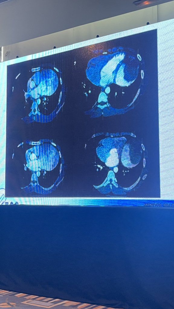 KITTA44's tweet photo. Indicaciones para tomografía y resonancia en cardiopatías
congenitas
Dra. Florangel Martínez

Bloque de Cardiologia Pediatrica del Congreso Nacional de Cardiologia  @CardiologiaSVC 

#svCardio23 https://t.co/3Its9GcP6S