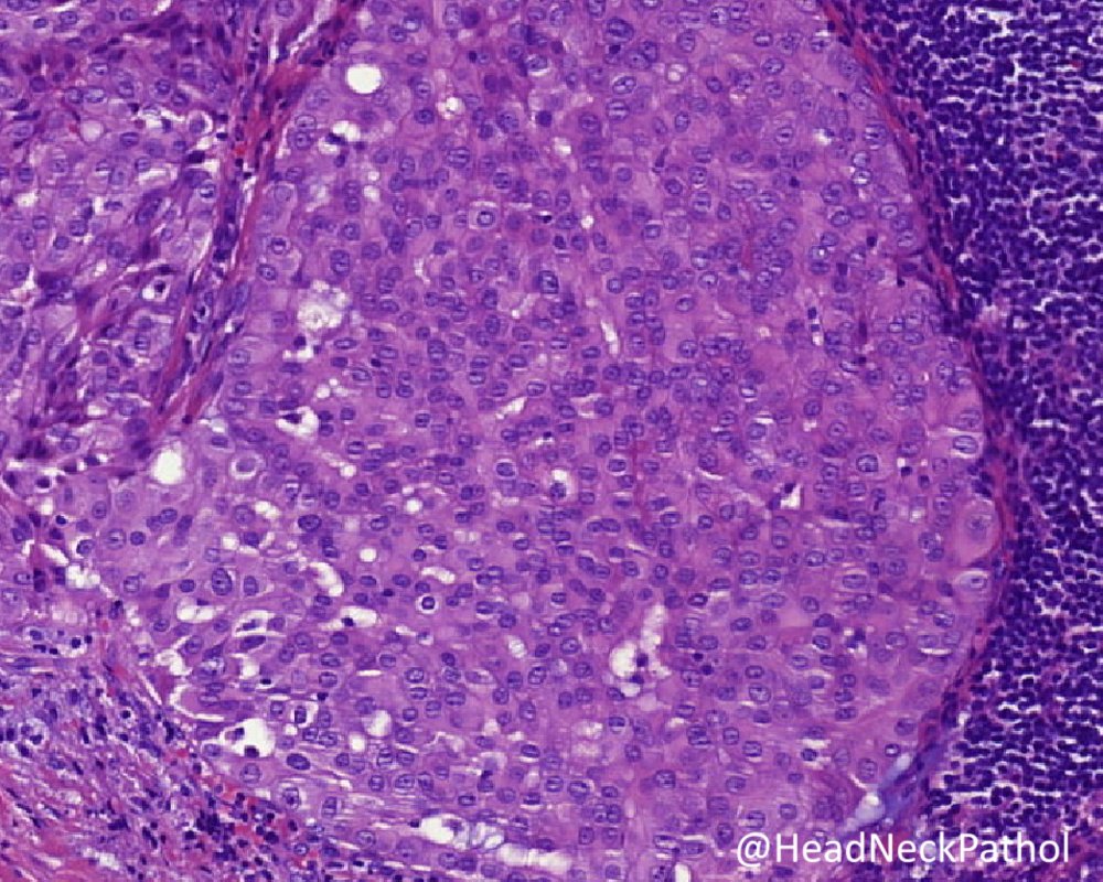 Proceedings of the 2023 NASHNP New Orleans Classification of Salivary Gland Tumors: Remaining Controversial Issues? Alena Skalova & Martin D. Hyrcza rdcu.be/dcO2T #HeadNeckPathol #HNPJ #HeadandNeckPath #Pathology #ENTPath #PathologyTweet