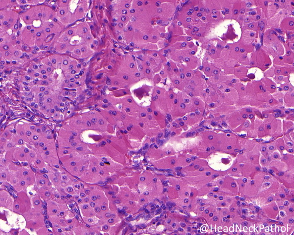 Proceedings of the 2023 NASHNP New Orleans Classification of Salivary Gland Tumors: Remaining Controversial Issues? Alena Skalova & Martin D. Hyrcza rdcu.be/dcO2T #HeadNeckPathol #HNPJ #HeadandNeckPath #Pathology #ENTPath #PathologyTweet