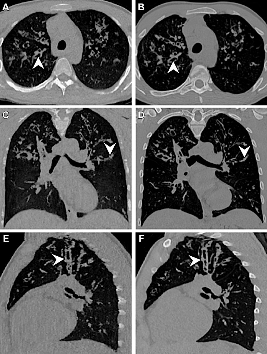 AI-generated synthetic CT images had better image quality than original MRI and agreed with real CT images for depiction of cystic fibrosis–related pulmonary alterations. bit.ly/44wcAM1