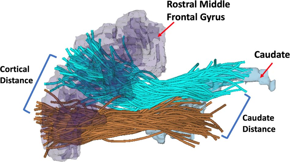 The organization of frontostriatal brain wiring in non-affective early psychosis compared with healthy subjects using a novel diffusion imaging fiber cluster analysis. By J. J. Levitt et al. @PNL_BWH_Harvard #brainwiring #psychosis #dMRI #psychiatry rdcu.be/decQu