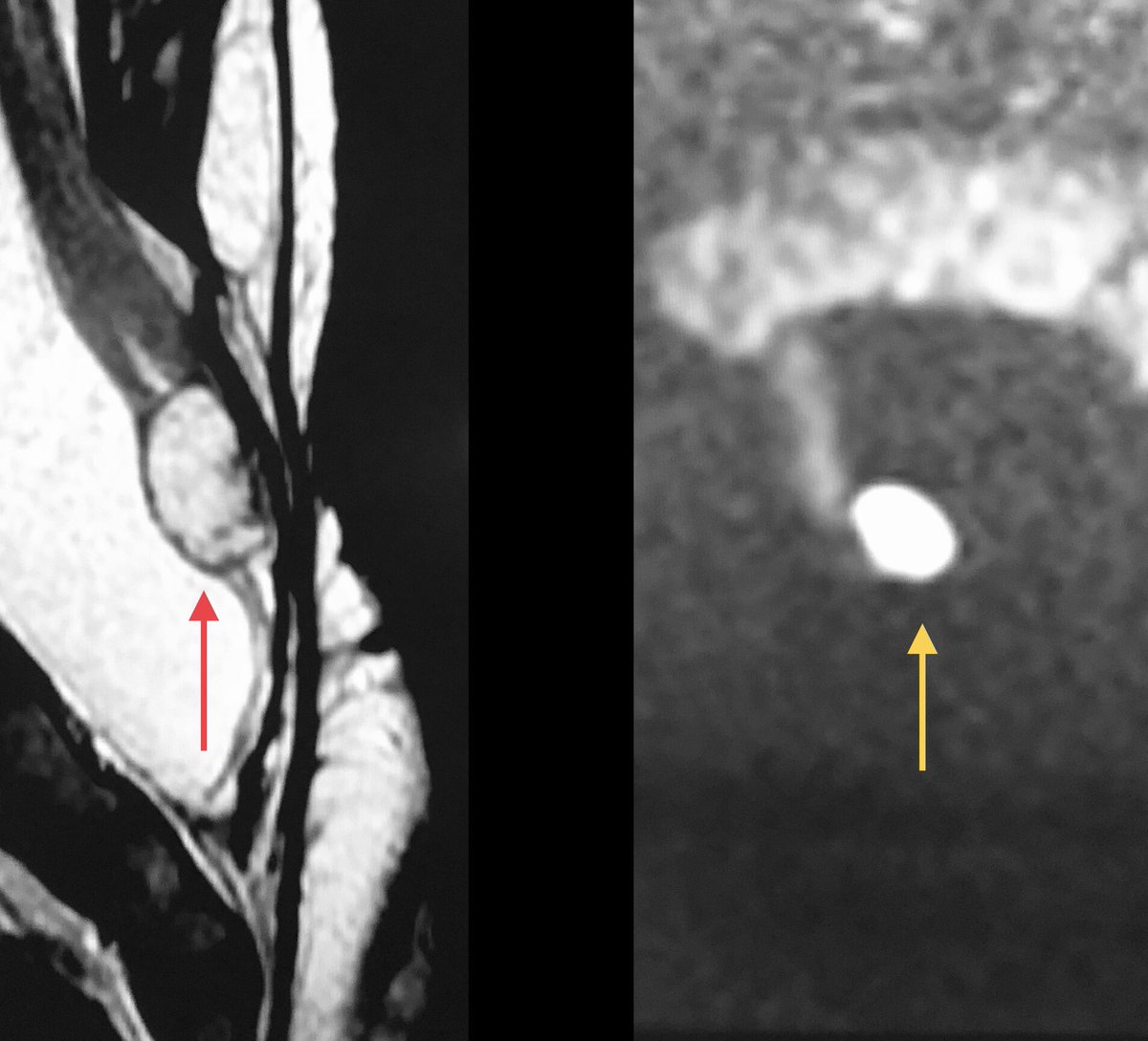 Epidermoid cyst may be found after myelomeningocele repair, showing the typical restricted diffusion nodule 🟡. 
👇
✅It’ s very useful to include DWI in the spinal dysraphism follow-up protocol