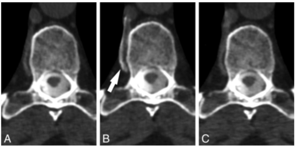 PeterGKranz's tweet photo. New paper now out in @TheAJNR from @DukeNeurorad team examining utility of resisted inspiration in patients with SIH caused by CVFs.
https://t.co/PnqXXSBzGF https://t.co/VFpZ82XaP2