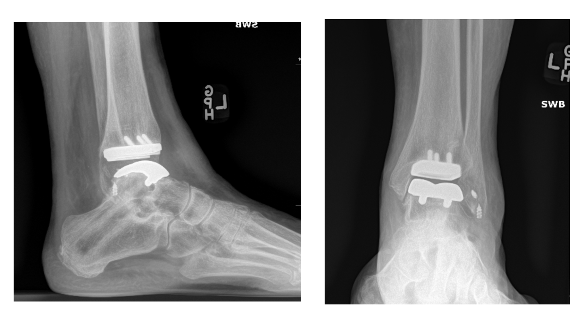 Here's the article we recently put out that talks about the safety and efficacy of performing Ankle Replacement on patients under the age of 55. Check it out!
journals.sagepub.com/.../10.1177/19…
#footandanklesurgeon
#totalanklereplacement
#podiatry
#anklesurgery