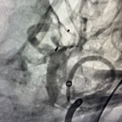 Boise Neurointervention (@stlukesnir) on Twitter photo #NewProfilePic #NewProfilePic