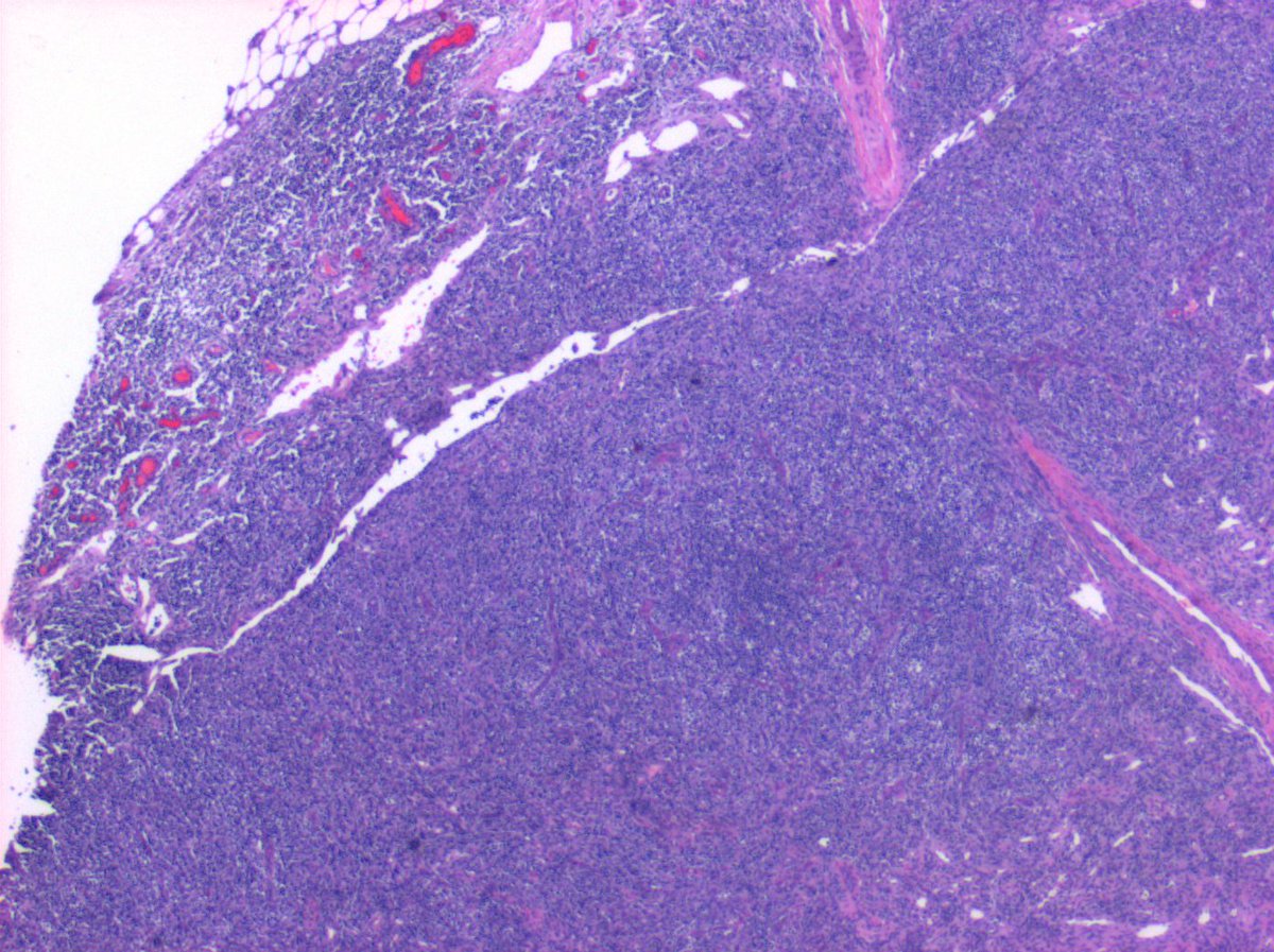 hemepathguy's tweet photo. #hemepath morphologic features of angioimmunoblastic T cell lymphoma UL - increased vasculature and clear cells LL - increased vasculature and eosinophils UR - spared subcapsular sinus, effaced normal architecture LR - lymphocytes with increased clear cytoplasm, varying size, https://t.co/u0eVuekR7M