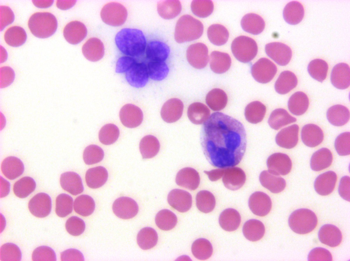 hemepathguy's tweet photo. #hemepath  A shop full of flowers? ATLL in blood https://t.co/SfZs3MCUrR