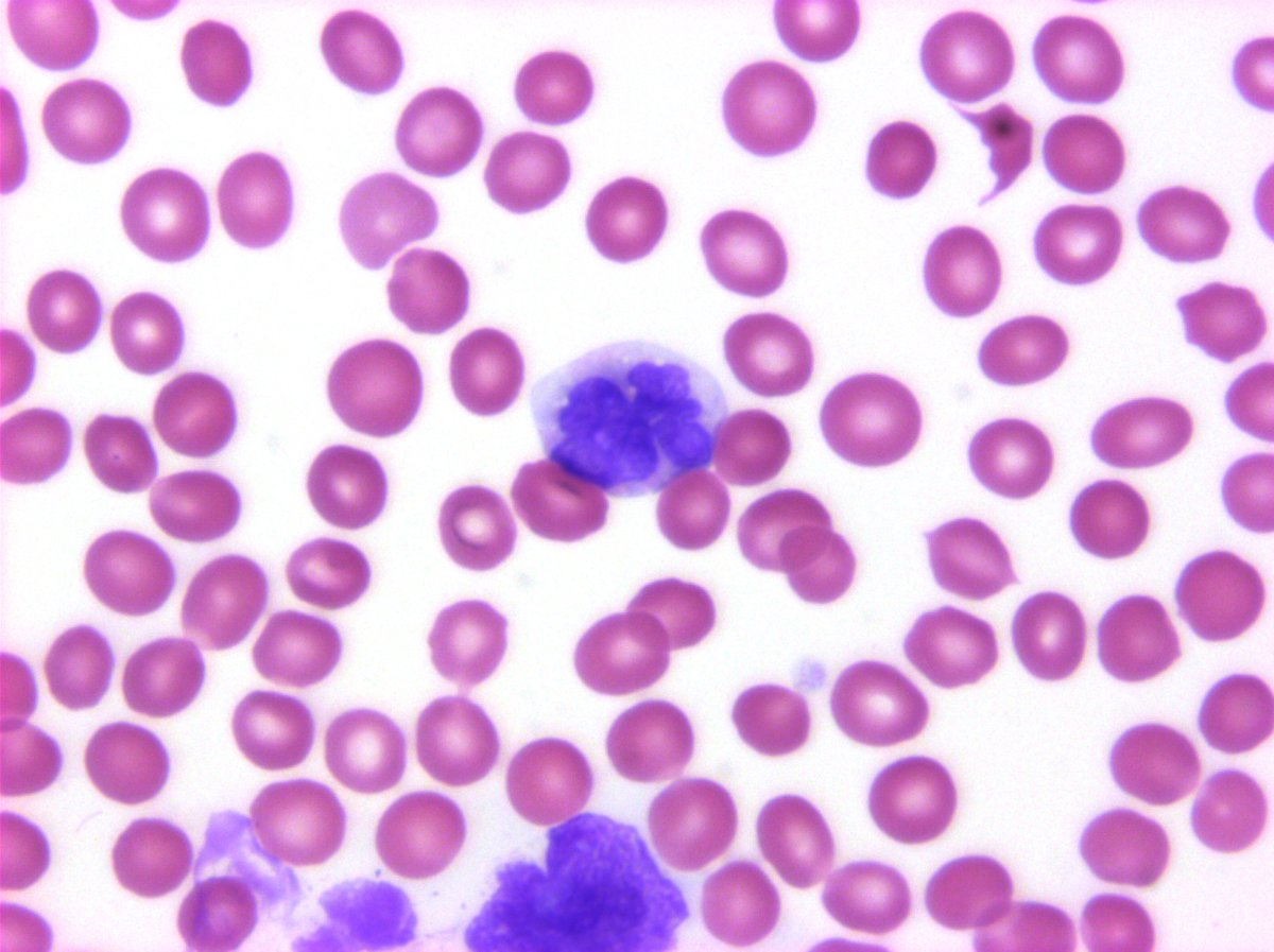hemepathguy's tweet photo. #hemepath  A shop full of flowers? ATLL in blood https://t.co/SfZs3MCUrR