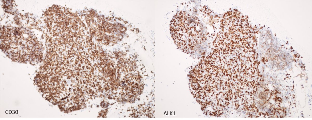 Lymph node with large ugly cells on DQ smears. Flow shows large cells negative for CD3/20, positive for
CD5/45. CD30 and ALK1 done on cell block-ALK Positive ALCL. #hemepath #cyto #pathtwitter #cytopath #pathology 
Bridging cyto and hemepath world!
