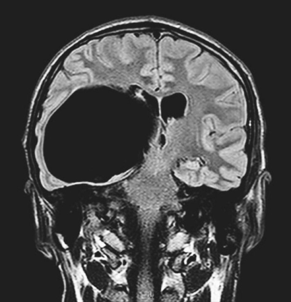 A 22-year-old man presented to the hospital after a motor vehicle collision in which his head struck the windshield of a bus. Initial observations and the physical and neurologic examinations were normal. A CT Scan was done. What is the likely diagnosis? @manualomedicine #MedEd
