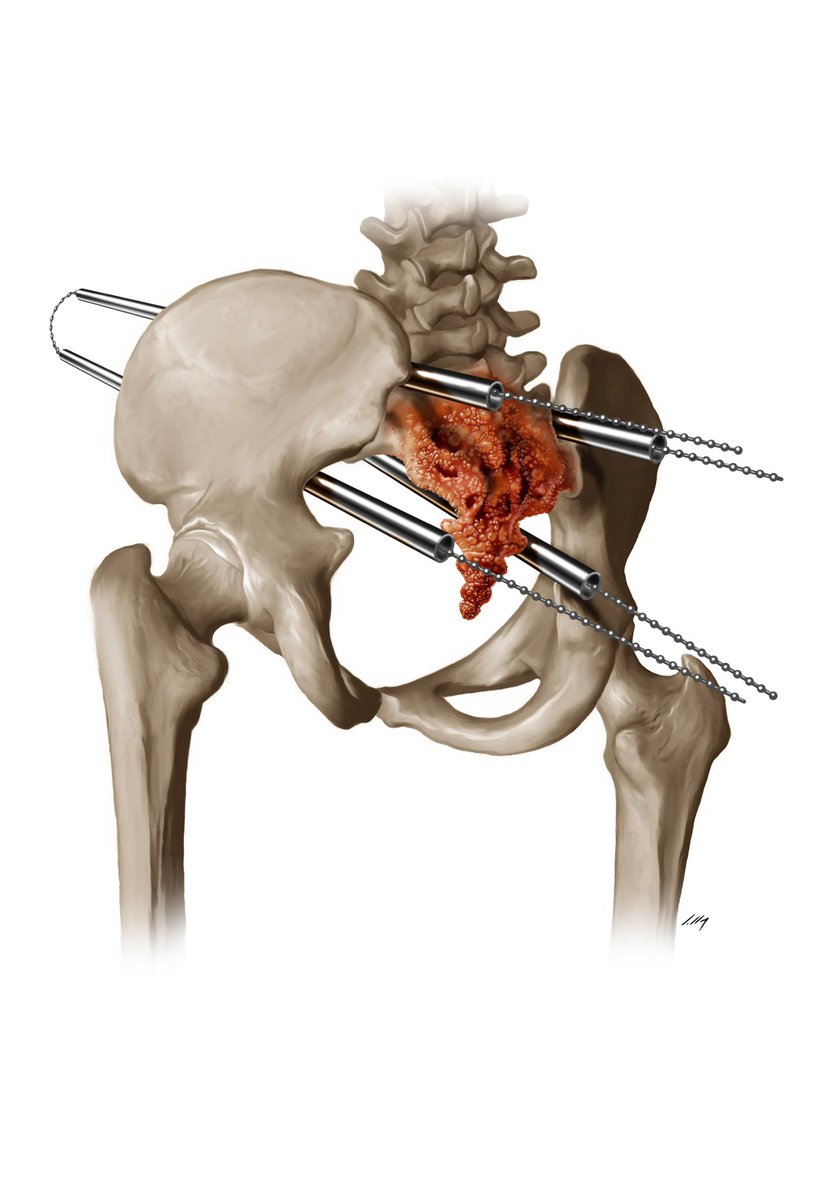 axlsalles's tweet photo. 2014 Sacral Surgery
#scientificillustration #sacralsurgery #surgicaltechnique #digitalpainting #commissionart #illustration #hipprosthesis #hipsurgery #sacraltumor https://t.co/od5lVp2hcV