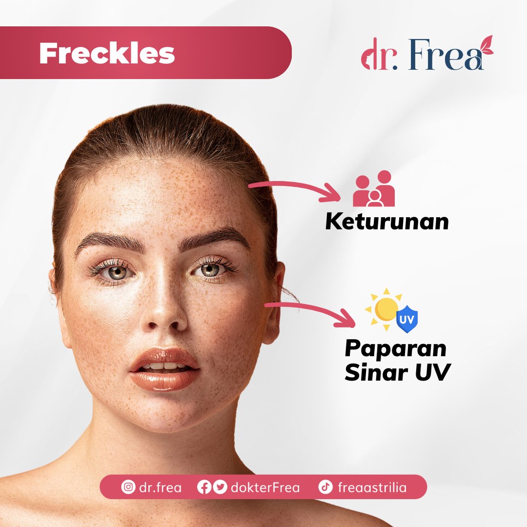 dokterFrea's tweet photo. Salah satu masalah kulit yang sering mengganggu adalah FLEK di wajah. Nah, jenis flek apa nih yang mengganggu wajah kalian? Yuk ramein kolom komentar &amp; sharing pengalaman kalian!

#flekhitam #flekwajah #freckles #melasma #lentigo #postinflammatoryhiperpigmentatio #cafeautlait https://t.co/qudLJP7MJs