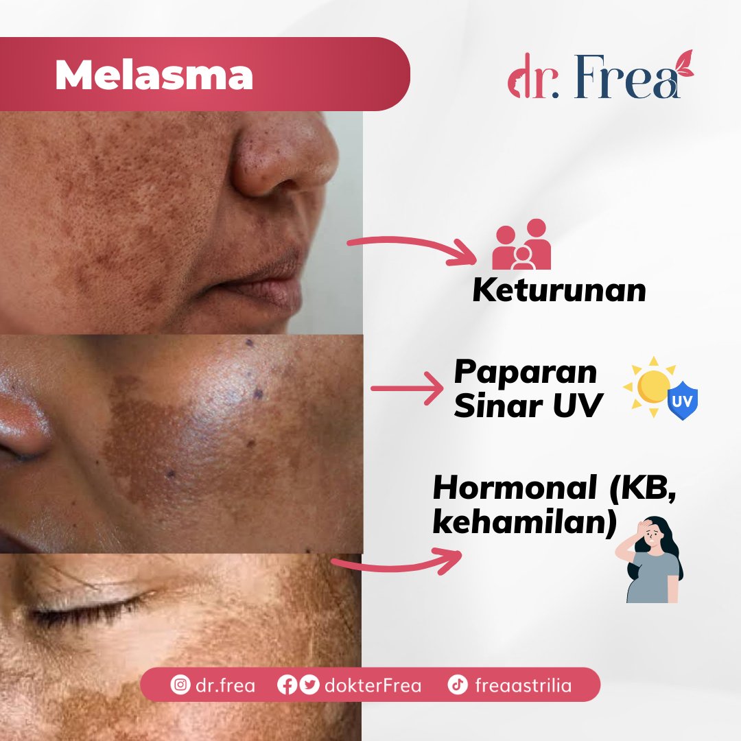 dokterFrea's tweet photo. Salah satu masalah kulit yang sering mengganggu adalah FLEK di wajah. Nah, jenis flek apa nih yang mengganggu wajah kalian? Yuk ramein kolom komentar &amp; sharing pengalaman kalian!

#flekhitam #flekwajah #freckles #melasma #lentigo #postinflammatoryhiperpigmentatio #cafeautlait https://t.co/qudLJP7MJs