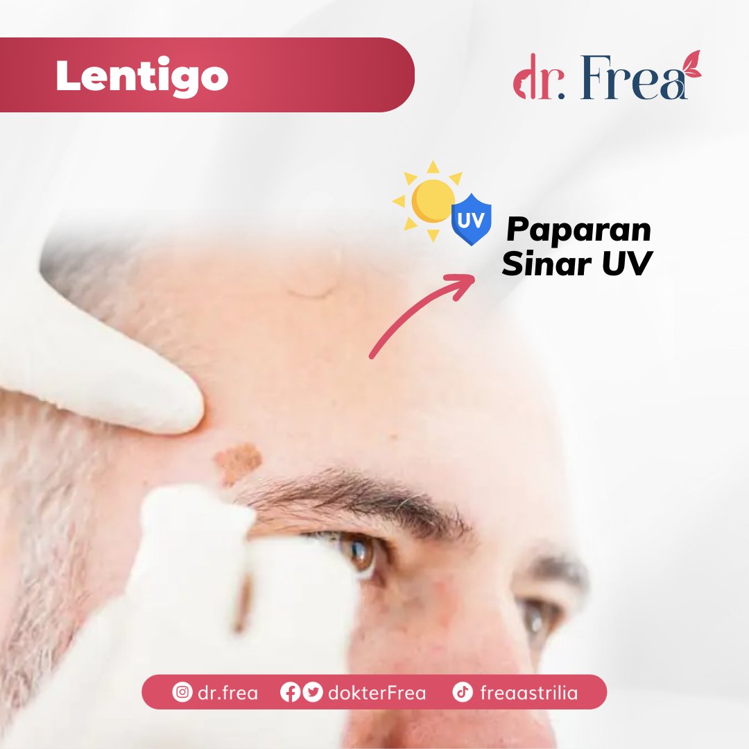 dokterFrea's tweet photo. Salah satu masalah kulit yang sering mengganggu adalah FLEK di wajah. Nah, jenis flek apa nih yang mengganggu wajah kalian? Yuk ramein kolom komentar &amp; sharing pengalaman kalian!

#flekhitam #flekwajah #freckles #melasma #lentigo #postinflammatoryhiperpigmentatio #cafeautlait https://t.co/qudLJP7MJs