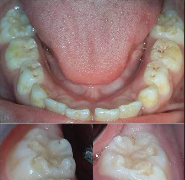 Spot Diagnosis.🍇
A 7 yo boy came for a routine health checkup. O/E: right submandibular lymphadenopathy &amp;the following finding was observed. What condition do you suspect? 
#MedTwitter #medicine #MedEd #Clinical #oralhealth #infectiousdiseases #dental