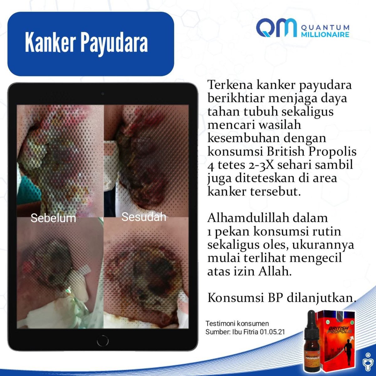 M1Roni's tweet photo. Kanker payudara...

https://t.co/73nErjZ032 https://t.co/Tuaw4hkhi0