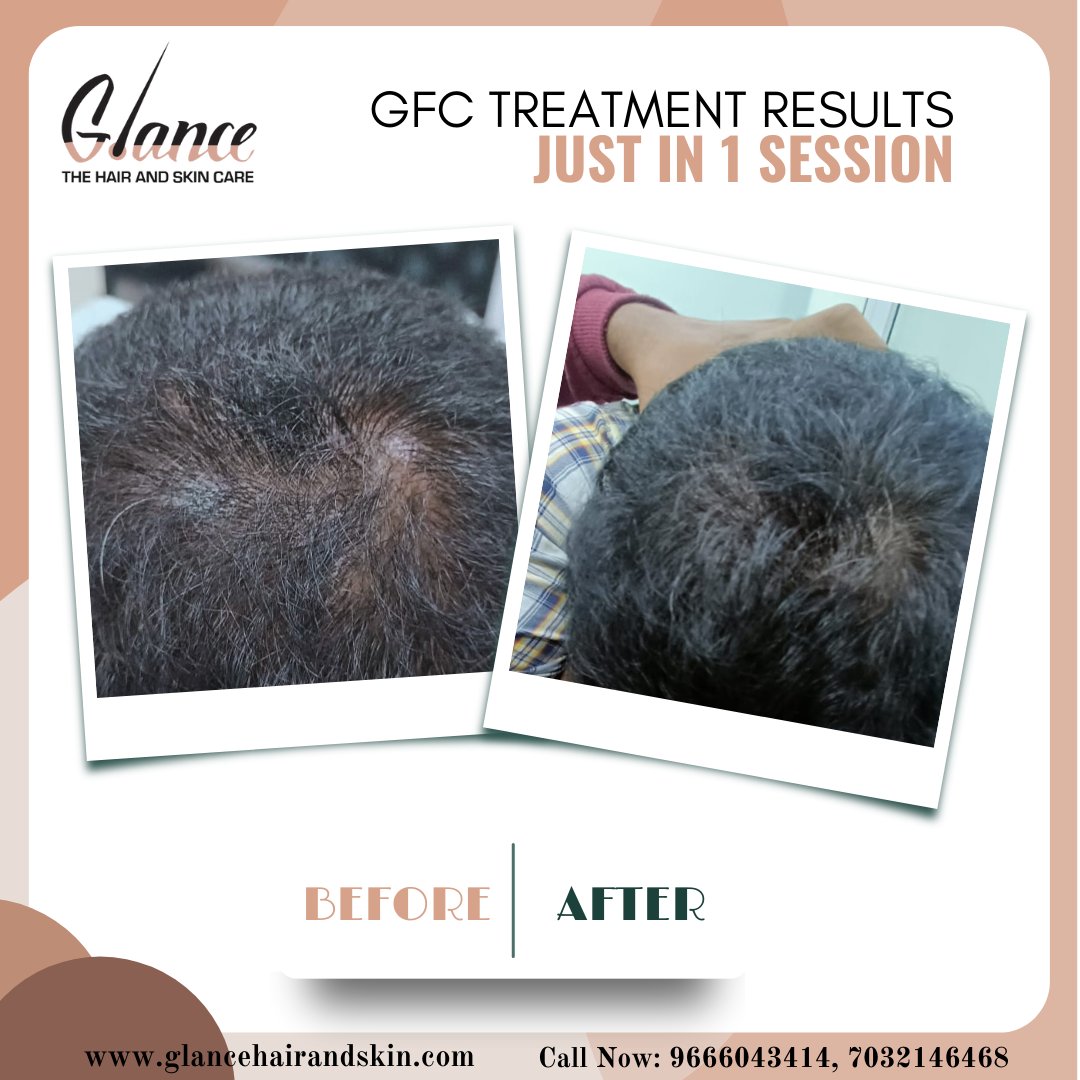 After 1 Session Of GFC Treatment

#gfc #prp #hairgrowth #hairregrowth #hairtransplant #doctor #glancethehairandskinclinic