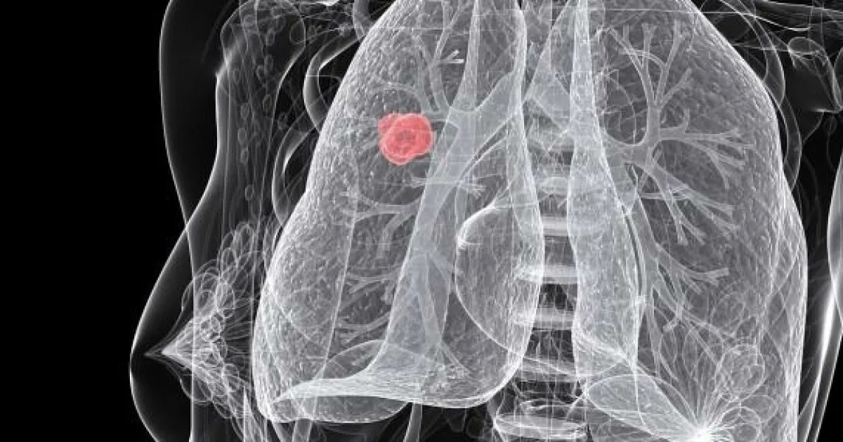 ⭕¿Es necesario el cribado de cáncer de pulmón? 
Tanto España como Europa apuestan por el cribado como estrategia para una detección temprana. ▶El reto, implementarlo también en cáncer de pulmón y facilitar el acceso a la innovación. 🗣Infórmate  aquí: buff.ly/44AxEAW