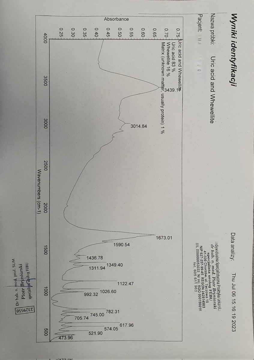 #KidneyStonePathophysiology. Do you know why this stone was formed? Patient with recurrent stone disease. History of total colectomy and ileostomy.