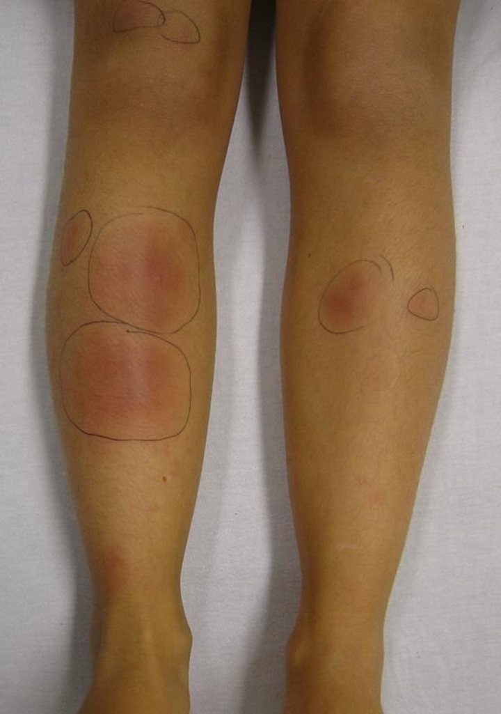 Marrow on twitter a 44 year old previously healthy lady presented
