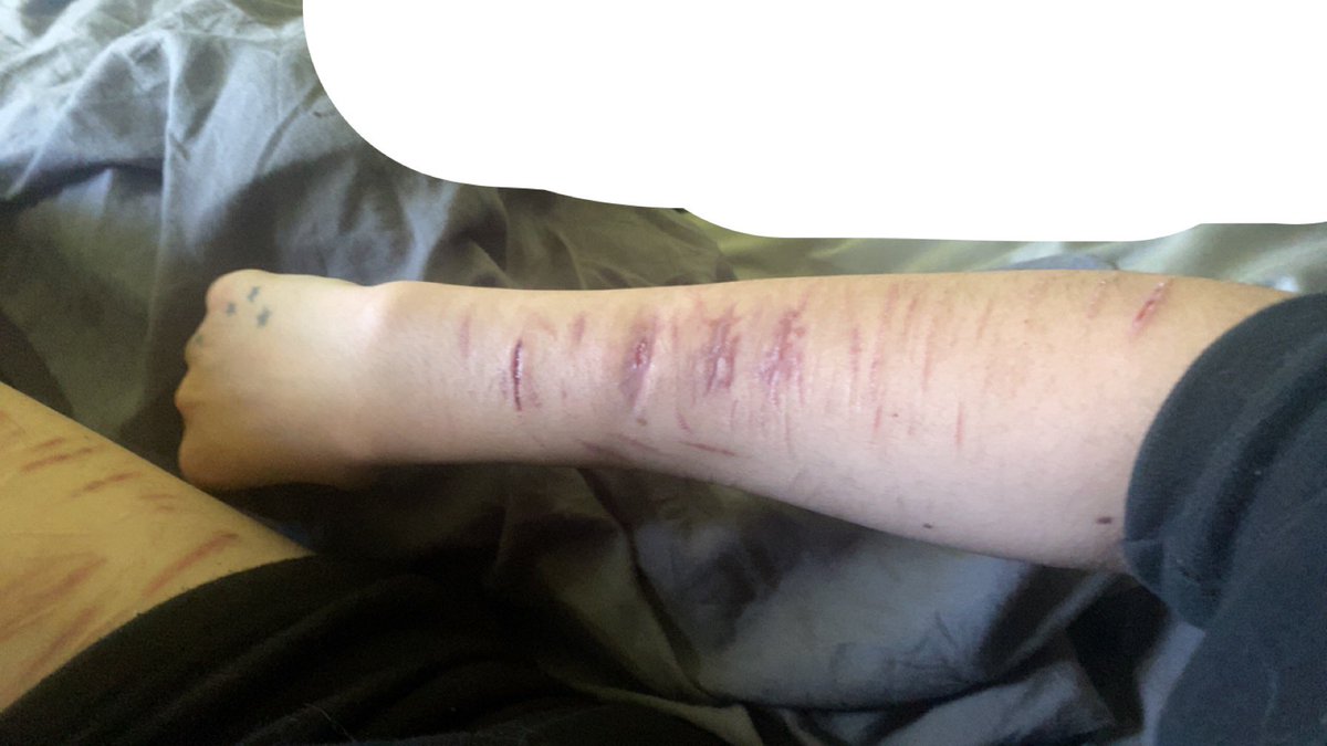 mwipulate's tweet photo. literally so in love wjth my scars https://t.co/NXhJfp4vZN