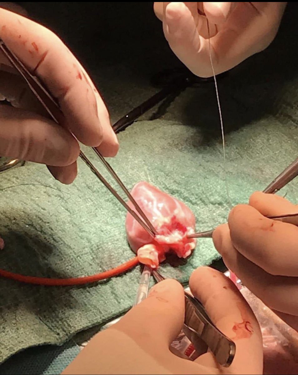 Bu ameliyatı yapan hekim 30 bin  maaş , 
Hekimi asiste eden hemşire 25 bin maaş . 
(Hekimle ,hemşire ameliyat ta en ufak hatası ölümle sonuçlanır . )

Ameliyathanede yere pas pas atan temizlikçi 33 bin maaş . ( Tek sorumluluğu mop’u kaybetmemek ) 

#SadakaDeğilZamİstiyoruz