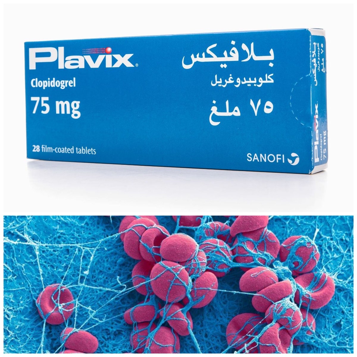 anazimd's tweet photo. بلافيكس

يحتوي دواء بلافيكس على المادة الفعالة كلوبيدوغريل، وهي مانع لتجلط الدم، يعمل على منع تراكم الصفائح الدموية التي يمكن أن تؤدي إلى الإصابة بسكتة دماغية أو أزمة قلبية.

💠   استخدامات البلافكس

• للقلب

•  ( يعطى مع الأسبرين)
-  في حالة إشتداد الإصابة بالذبحة الصدرية غير المستقرة
-  بعد حدوث الجلطة القلبية
-  بعد تركيب الدعامات التاجية
•  (يعطى منفردآ)
-  للوقاية طويلة الأمد لمن لا يتحملون الأسبرين

• لأمراض الشرايين الطرفية

• للمرضى الذين تعرضوا مسبقاً لسكتة دماغية كاملة أو عابرة

💠   أفضل وقت لتناول الدواء 
مرة واحدة يومياً في نفس الموعد دون تغيير، ولا يشترط صباحاً أو مساءاً 

💠   الجرعة
-  عمومآ 75 ملجم مرة يوميآ
-  في حالة الخضوع لقسطرة عاجلة  لتركيب الدعامات التاجية يعطى المريض ما مجموعه 300 إلى 600 ملغم غي مامجموعه 4 إلى8 أقراص لتحفيز المفعول 

💠   الاعراض الجانبية لبلافيكس

• بعد الإستخدام لأول مرة
الحساسية
• بعد الاستخدام المتكرر
-  الرضوض والكدمات وهي في العموم غير خطيرة وليست مسوغ لوقف الدواء
-  ( إن كان هناك مصدر  متوقع للنزيف)  فقد تزيد حدة النزيف مع تناول البلافيكس  مثلآ : الإرعاف أو النزيف من البواسير 

💠   موانع الإستخدام 

•  النزيف  النشط
•  نزيف القرحة المعوية
•  نزيف  الجمجمة
•  فرط الحساسية للدواء

💠    التداخلات الدوائية

•  في حالة الحاجة لعلاج حموضة المعدة لمن يستعمل البلافيكس ،  يفضل أخذ علاج بانتازول  بدلآ من نكسيوم
•  الحذر من خلط البلافكس مع مسيلات الدم الأخرى مثل( وارفارين  زاريلتو  ابيكسابان ) لإرتفاع خطر النزيف