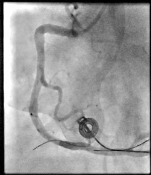 ShaojieChen1's tweet image. D2B ~20 🚑 
#EPeeps also #PCI #revascularization 
🙌🙌
@jongichun 
@BorisSchmidt5 
cc @ecgrhythms @AGIKinterv @AGEP_DGK @SchakrabartiEP @adnanalkhouli @docsaw @JoaoLCavalcante @AGoldsweig @SHDcathman @DrTomEP @DeeDeeWangMD 
@KardiologieHH @ANazmiCalik @Hragy @MaruanCarlos…