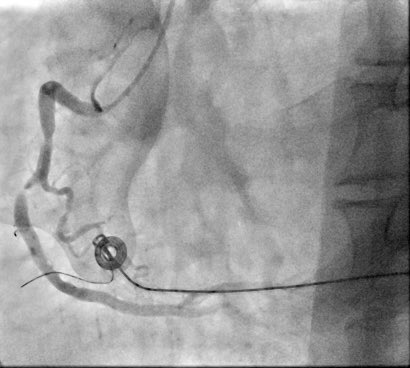 ShaojieChen1's tweet image. D2B ~20 🚑 
#EPeeps also #PCI #revascularization 
🙌🙌
@jongichun 
@BorisSchmidt5 
cc @ecgrhythms @AGIKinterv @AGEP_DGK @SchakrabartiEP @adnanalkhouli @docsaw @JoaoLCavalcante @AGoldsweig @SHDcathman @DrTomEP @DeeDeeWangMD 
@KardiologieHH @ANazmiCalik @Hragy @MaruanCarlos…