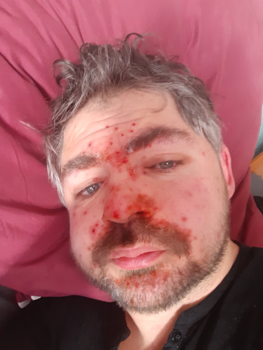 🌡Hey friends...Im pretty sorry for beeing inactive the last week. My little one got a pretty bad virus infection and so I tried it out too, causing me to be KOed for days and having paralysed fingers. Ill be back as soon as I can move my hands again. Love you all