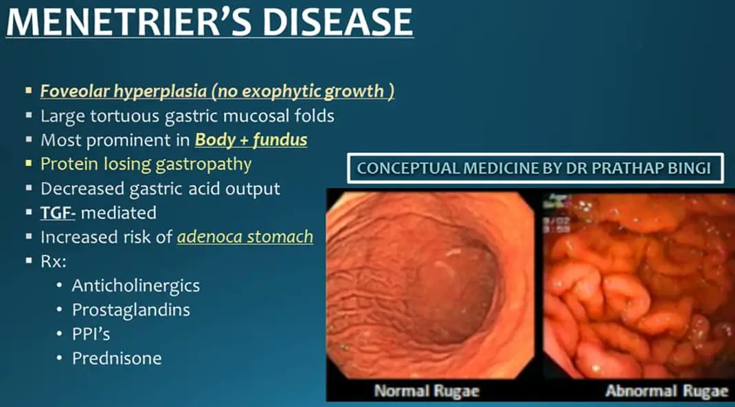 DrShady_Yousif's tweet photo. @drkeithsiau 💠Menetrier disease.
✅Dx:
1️⃣Aka hypoproteinemic hypertrophic gastropathy.
2️⃣Rare.
3️⃣Characterized by:
☑Giant mucosal folds in the proximal part of the stomach.
☑Diminished acid secretion.
☑Protein-losing state w/ hypoalbuminemia.
4️⃣Common in middle-aged men.
@IhabFathiSulima https://t.co/smW4ZovUA9