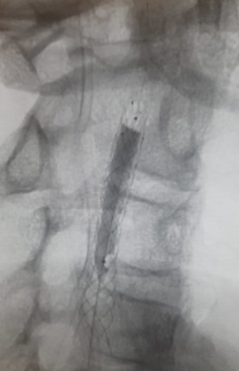 AlexRuebben's tweet photo. In-stent restenosis treated with #ELUTAX3 #DCB one of the most versatile Drug coated balloons on the market. https://t.co/sZ9aMq6cbH