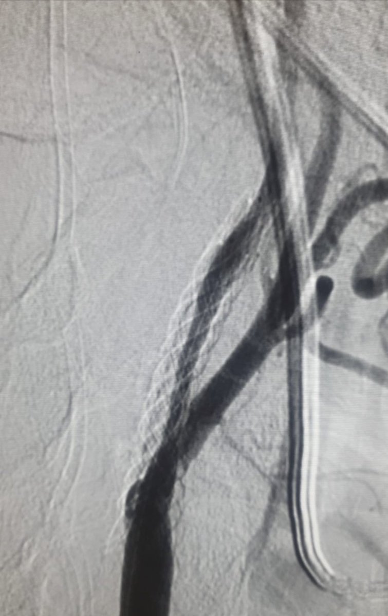 AlexRuebben's tweet photo. In-stent restenosis treated with #ELUTAX3 #DCB one of the most versatile Drug coated balloons on the market. https://t.co/sZ9aMq6cbH