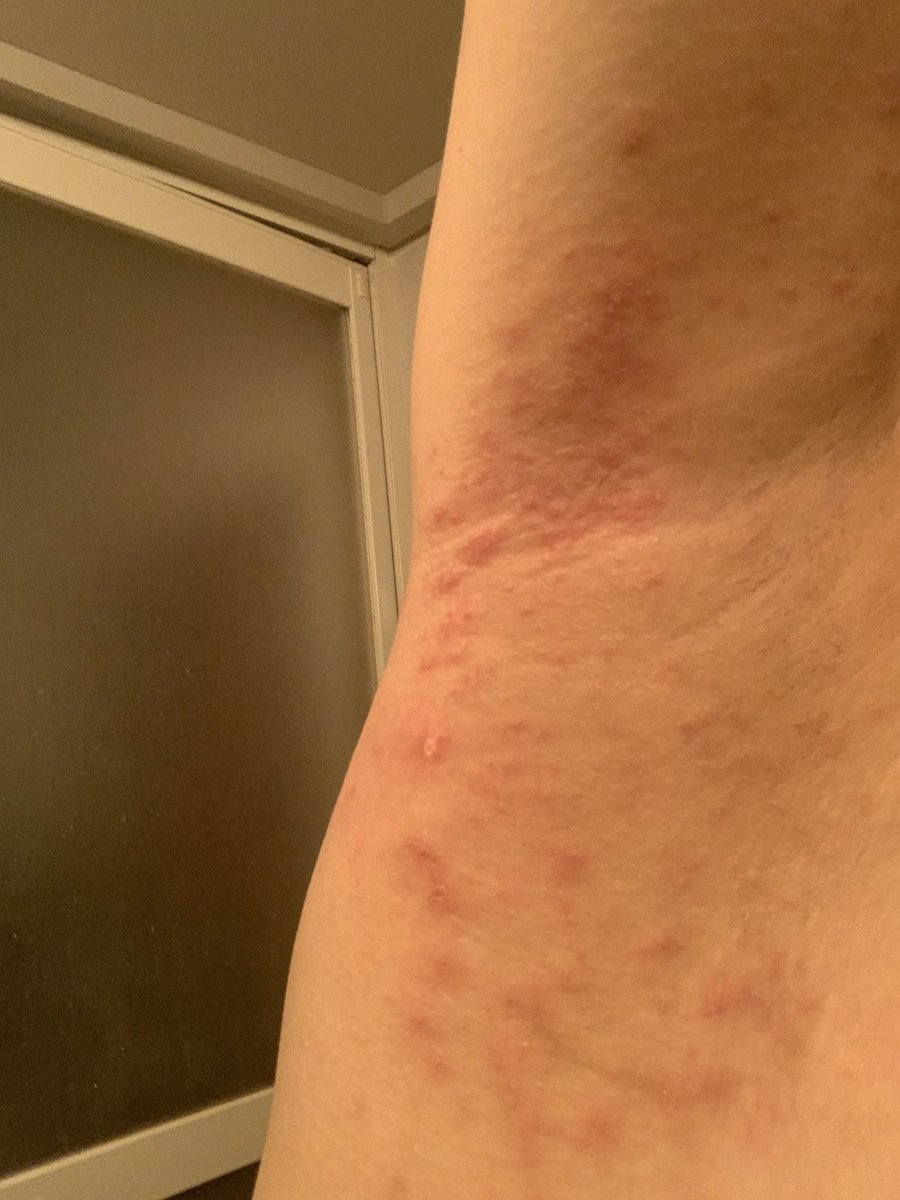 nohn1996's tweet photo. コロ縄クチン未接種なのに、これは…
シェディング…

1ヶ月の謎のかゆみの正体が今日分かって
ニガリを患部に塗って栄養療法で治す

かゆくて寝くれなかったけど、
今日は1ヶ月ぶりに…🥲ぐっすり眠れそう😢嬉しい… https://t.co/3syzJT9zI0