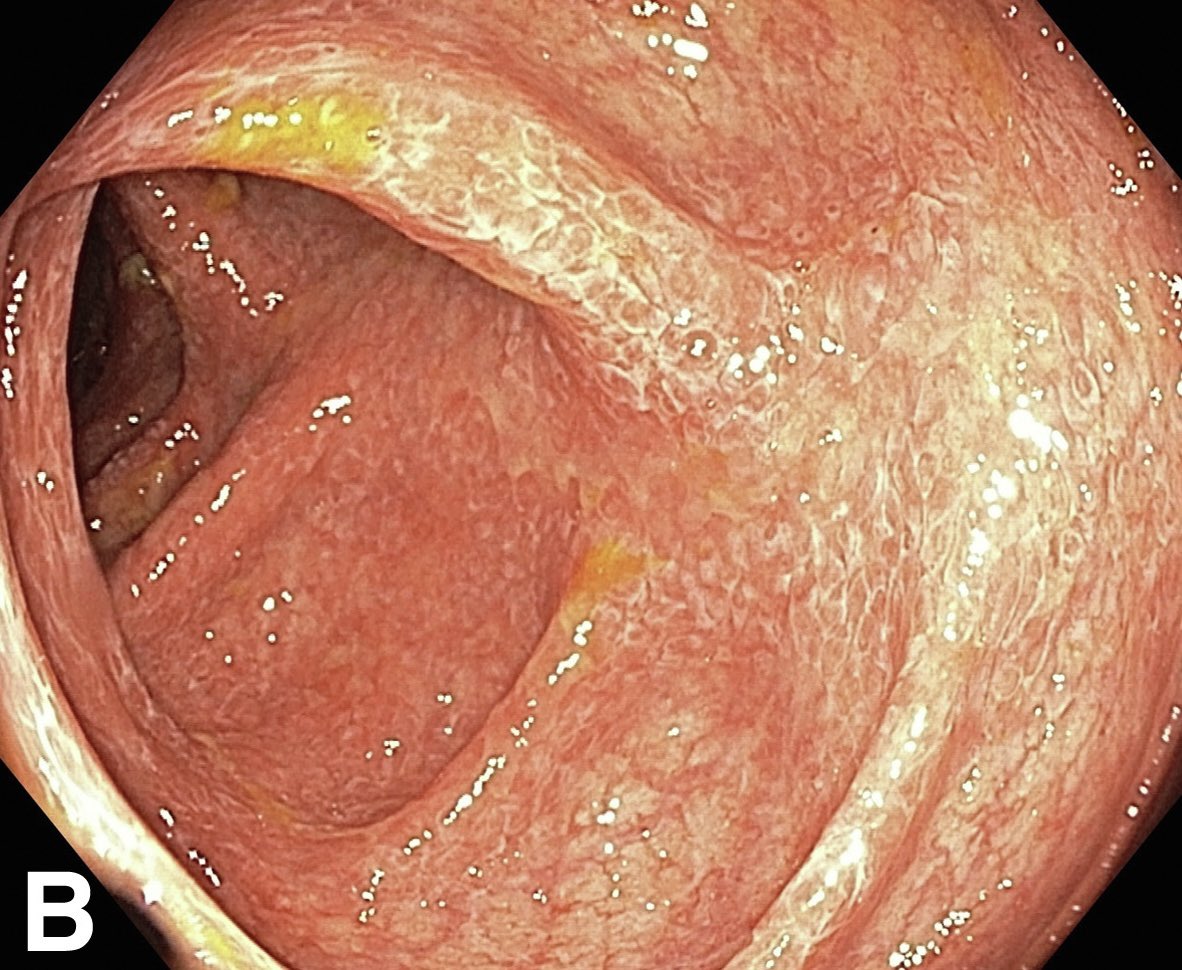 Fascinating case in @GIE_Journal of a 63 year old with Covid pneumonia and diarrhoea. Colonoscopy showed pan-colitis mimicking IBD, however, biopsies were positive for nucleocapsid and spike protein of SARS-CoV-2, consistent with Covid-19 colitis. giejournal.org/article/S0016-…