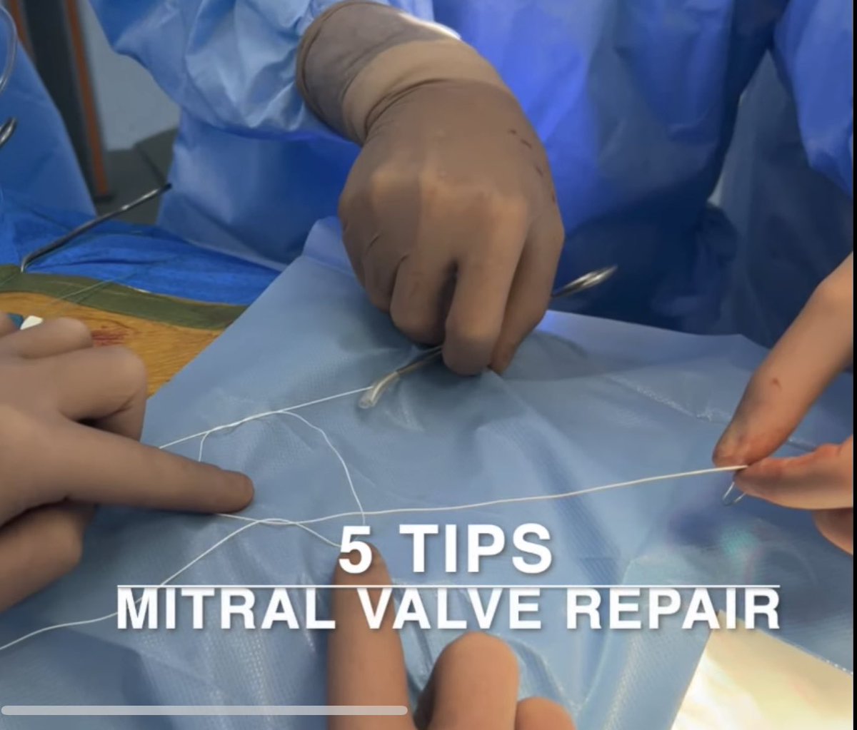 Check out these tips for #MitralValveRepair:
1️⃣ Keep the heart closer;
2️⃣ Pupillary muscles exposure;
3️⃣ Safadi knot;
4️⃣ Test the valve🩸;
5️⃣ Hide the knots.

For full information and mind-blowing visuals, check out 👉 youtu.be/IXhVN1zbyVw.
Prepare to be amazed! #SurgicalTips
