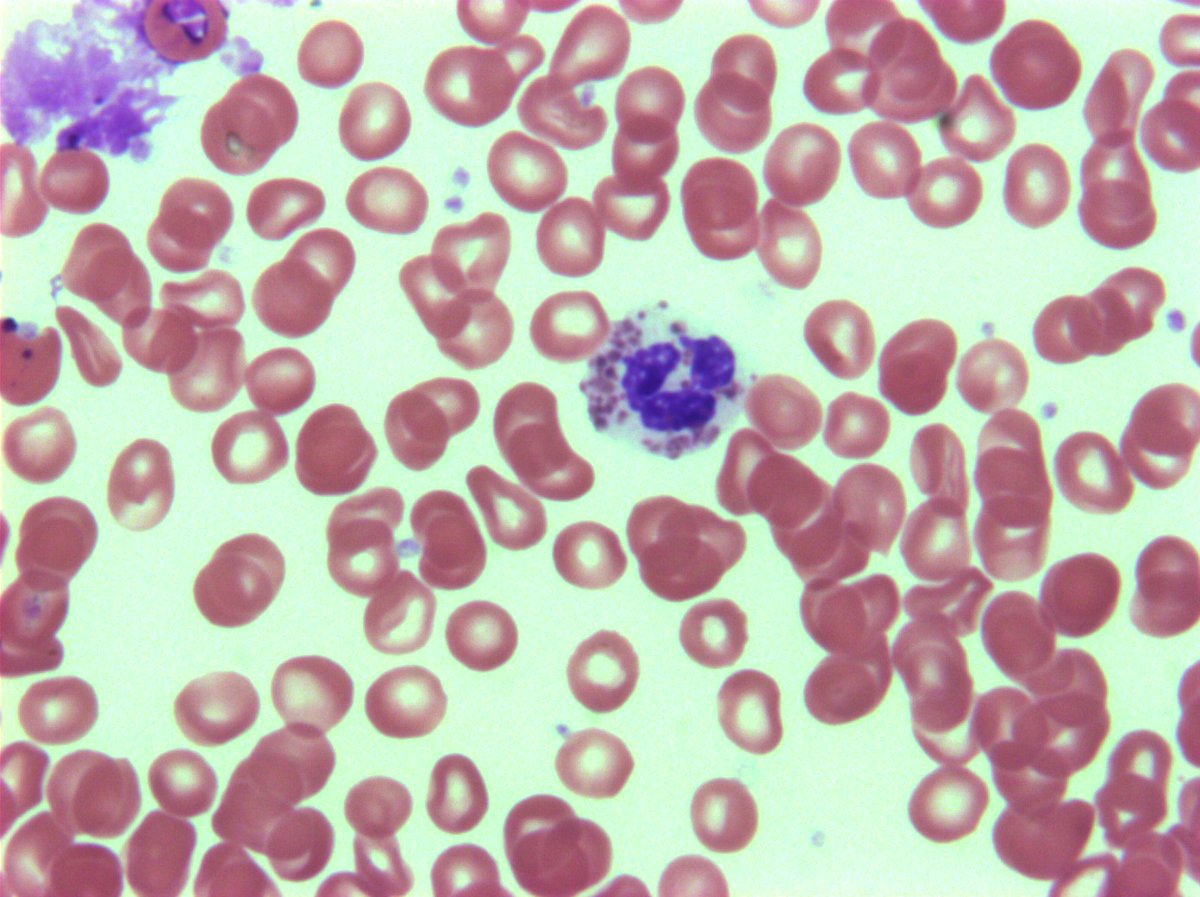 hemepathguy's tweet photo. #hemepath fresh from the camera. Chediak-Higashi in PB https://t.co/zFMtn9lsbk