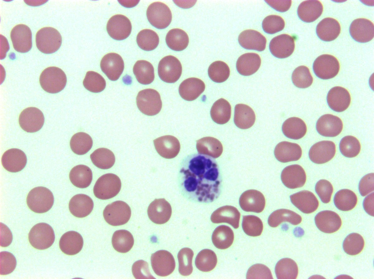 hemepathguy's tweet photo. #hemepath fresh from the camera. Chediak-Higashi in PB https://t.co/zFMtn9lsbk