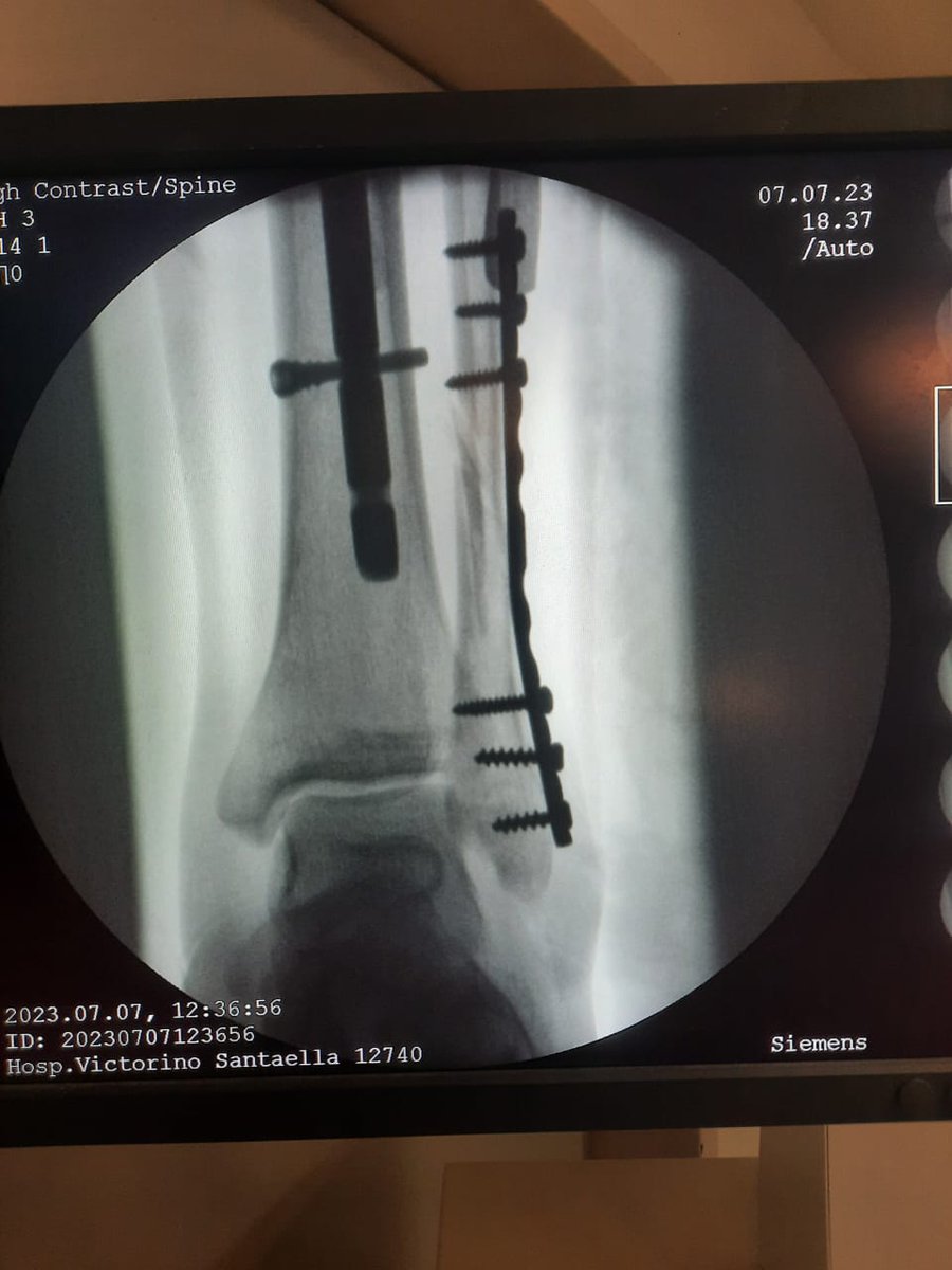 OscarNavas's tweet photo. 2) Redujimos la tibia (el hueso más voluminoso que ven las imágenes) e hicimos un enclavado endomedular bloqueado (le pusimos un clavo de tibia que tiene tornillos en sus extremos, eso le da el nombre de "bloqueado").
3) Luego volvimos al peroné y pusimos una placa 1/3 de caña. https://t.co/Nb2eZGhrgl