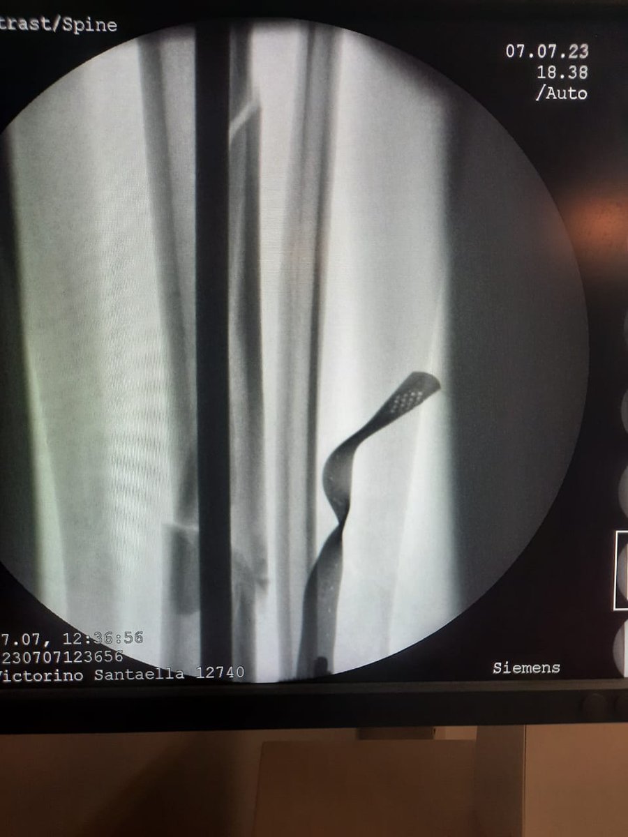 OscarNavas's tweet photo. 2) Redujimos la tibia (el hueso más voluminoso que ven las imágenes) e hicimos un enclavado endomedular bloqueado (le pusimos un clavo de tibia que tiene tornillos en sus extremos, eso le da el nombre de "bloqueado").
3) Luego volvimos al peroné y pusimos una placa 1/3 de caña. https://t.co/Nb2eZGhrgl