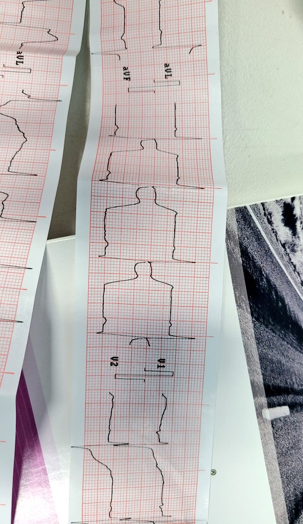 cardioalejandro's tweet photo. Dead man sign
#ICP #SCACEST #Rightcoronaryartery https://t.co/BqCIpLHbrV