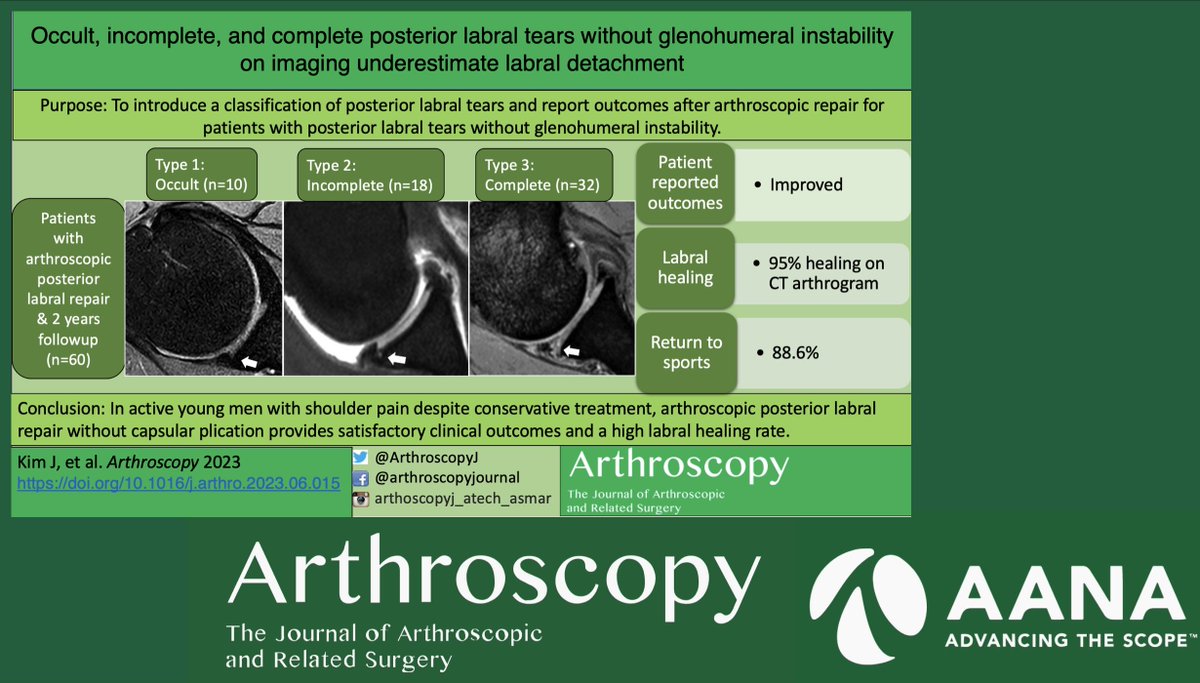 ArthroscopyJ's tweet image. #Posterior #Labrum #Tears of the #Shoulder without #Instability underestimate labral detachment... a #Classification system....