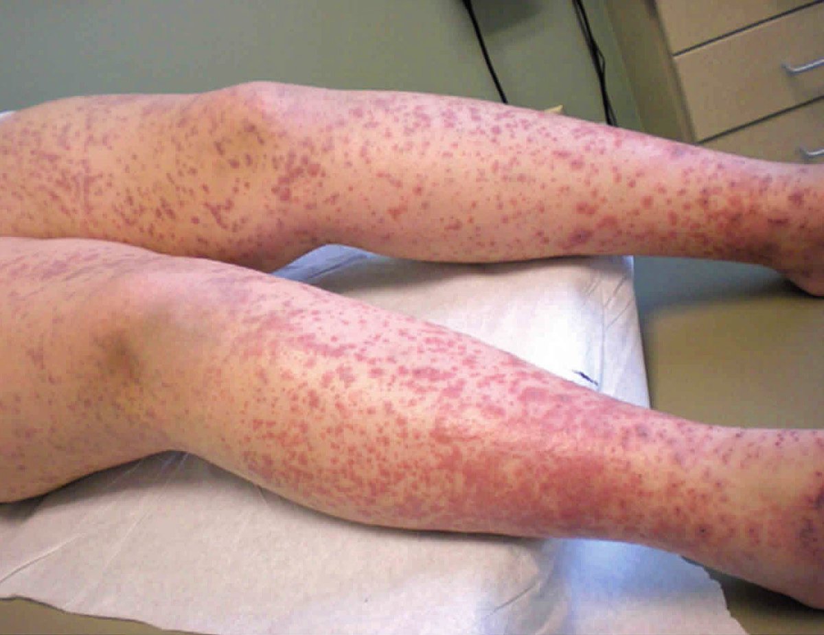 The coagulogram of this patient shows increased  
Prothrombin time &amp; Activated Partial Thromboplastin time  
with Platelet count of 1.2 L/mm³. What's the diagnosis?

A Henoch-Schonlein Purpura
B Acute ITP
C DIC
#MedTwitter #medicine #Clinical #MedEd #Medical #Health #pathology