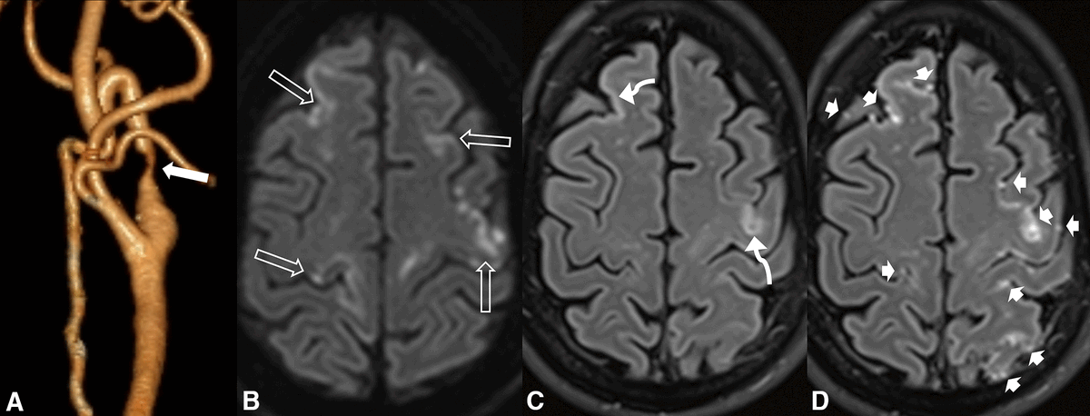 Excellent read in the latest issue of Neurographics. 

Brain surface enhancement on FLAIR (BSEF) is seen as an increased FLAIR signal related to the surface of the brain following gadolinium-based contrast agent (GBCA) administration.

BSEF includes leptomeningeal enhancement on…