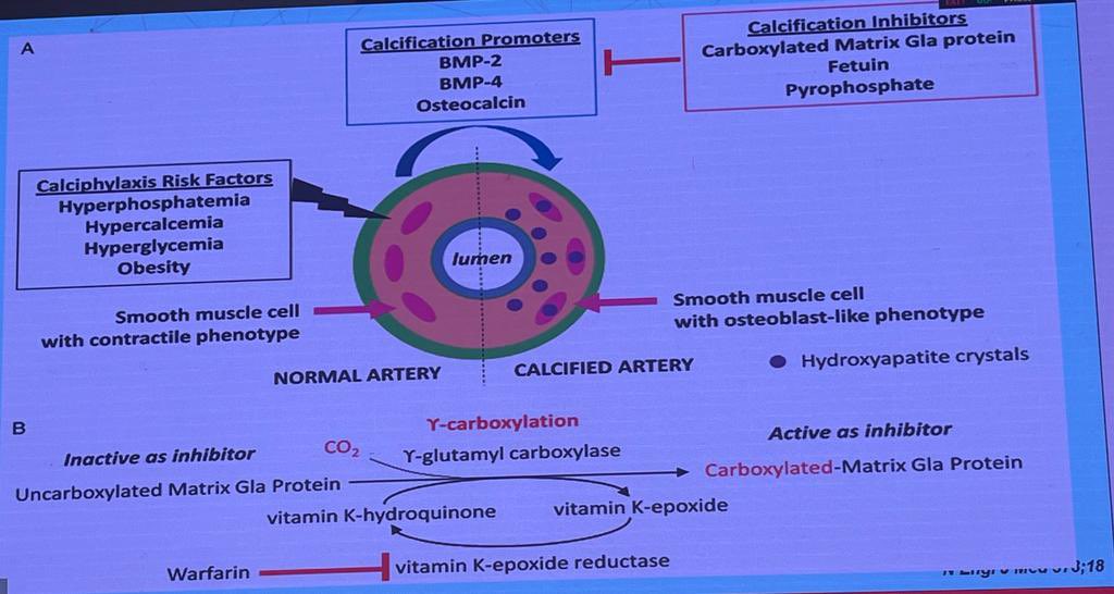 🔥Calciphylaxis in CKD✅💀

Dr Deodatta C @AVATAROrg #NSW2023 

☠️Lethal disease-Cutaneous ischemic infarct-occlusion of blood vessels🩸in subcutaneous fat/dermis

🤖Risk on PD >HD 

⚠️Risk- hyperPO4/Vit K antagonist/Warf/Active Vit D/DM/hypercoagulable state/RRT vintage/🙋‍♀️sex