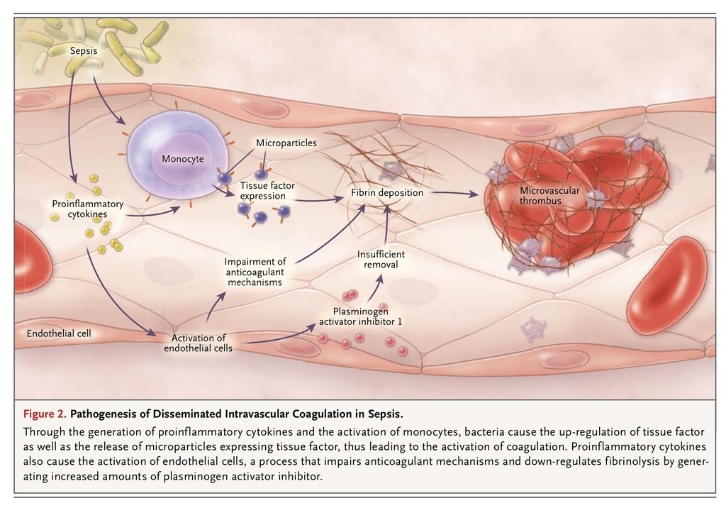 Drgomathi_tn's tweet photo. @Shashankk0007 Good!🏆 aka Consumption Coagulopathy where PT/aPTT are elevated with low platelet count &amp; fibrinogen levels due to extensive clot formation. https://t.co/defVq7oRbI